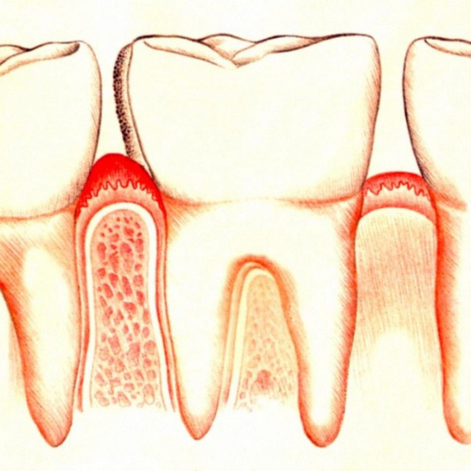 vospalilas-desna-okolo-zuba-lechenie