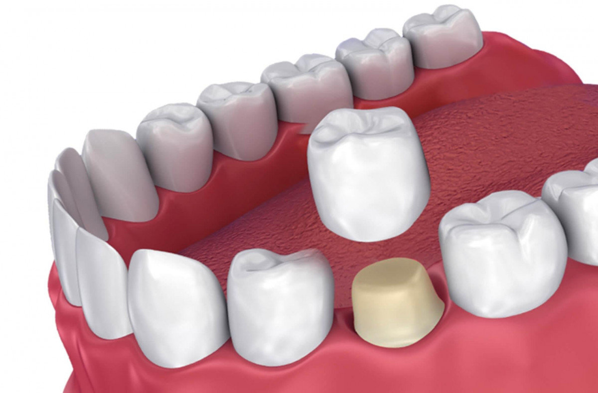 skolko-stoit-postavit-koronku-na-zub